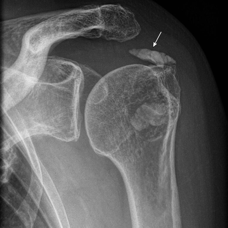 Calcific Tendonitis