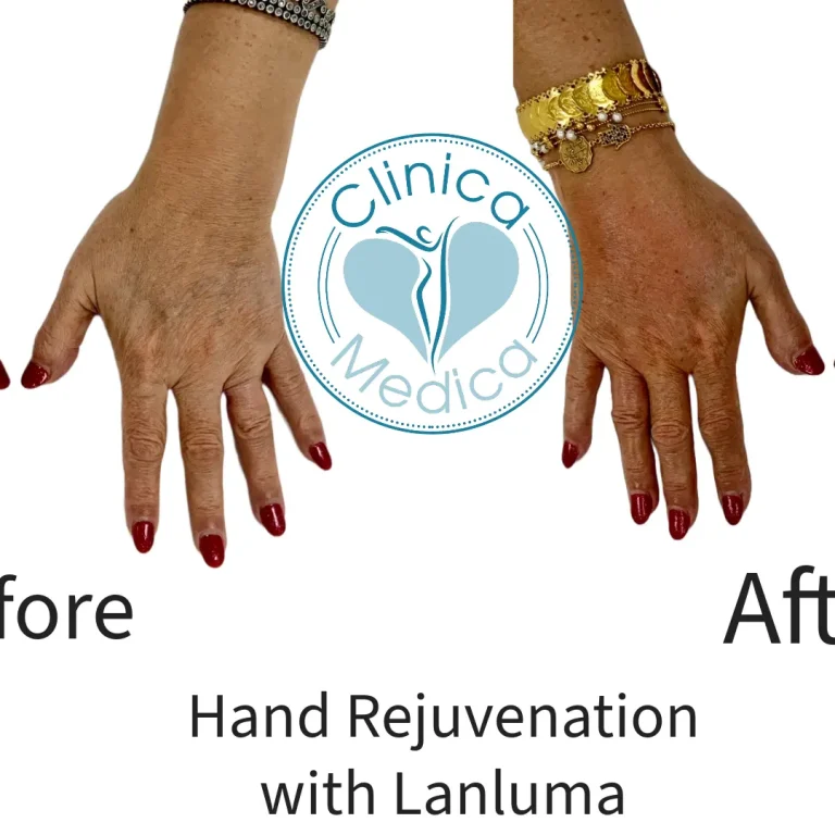 Lanluma-Hands-Before-and-After