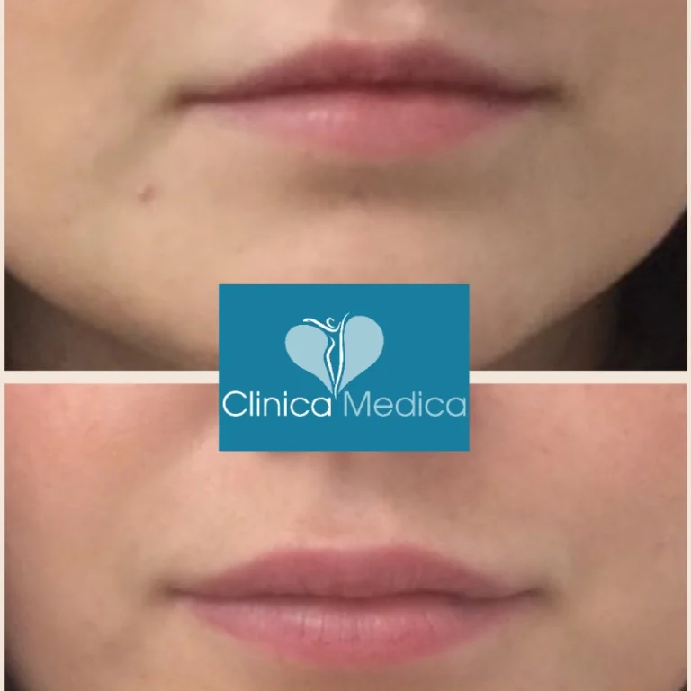 a-guide-to-lip-filler