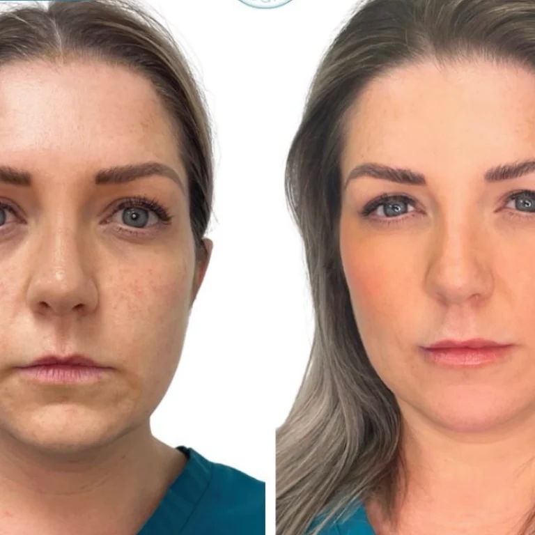 how-facial-fillers-can-help-rejuvenate-you