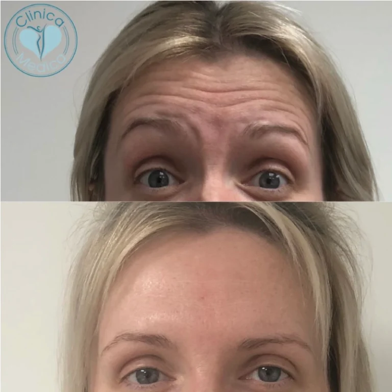 wrinkle-relaxing-injections